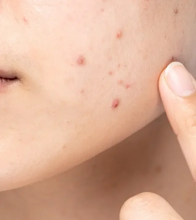 Acne & Pimples