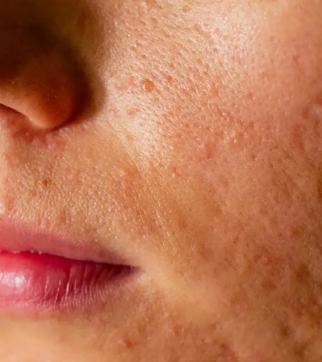 Facial Spots & Blemishes