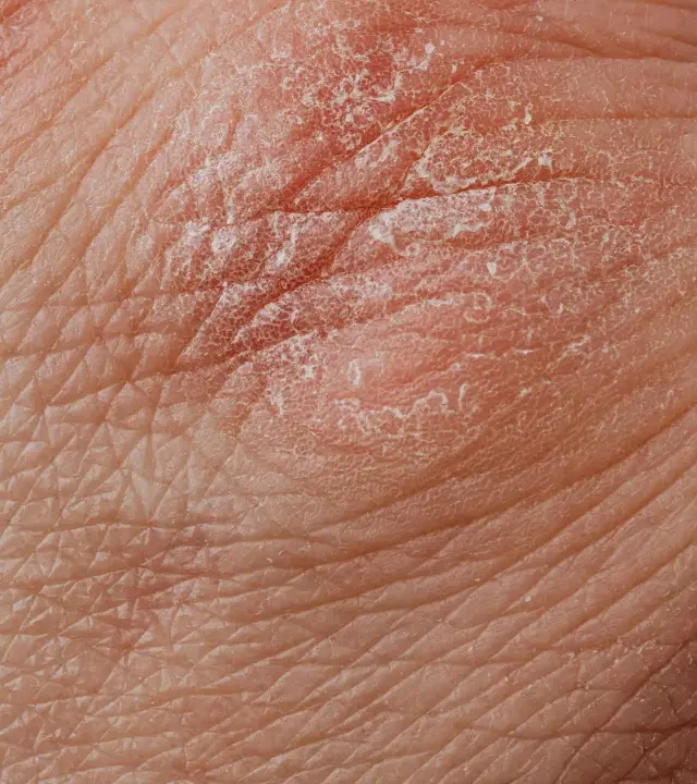 Psoriasis Treatment