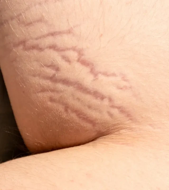 Stretch Mark Treatment