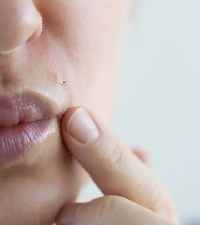 Unwanted Facial & Body Hair Removal